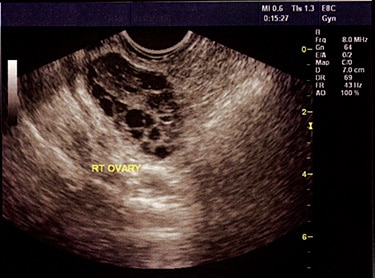 PCOS Ultrasound